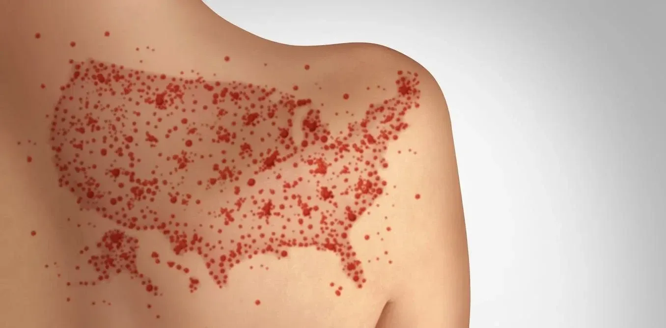measles