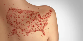 measles